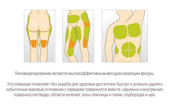 липосакция талии цена липосакция талии цена