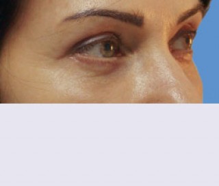 Удаление глазных грыж в глазной клинике