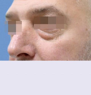 Удаление глазных грыж в глазной клинике