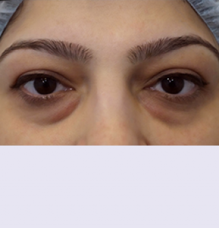 Удаление глазных грыж в глазной клинике thumbnail