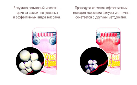 Вакуумно-роликовый массаж