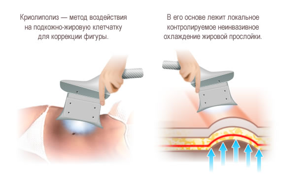 Метод криолиполиза