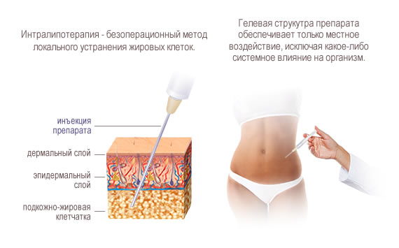 Методика интралипотерапии