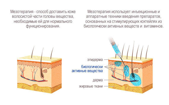 Сделать мезотерапию для волос