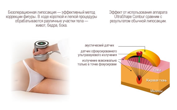 Методика безоперационной липосакции