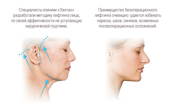 Безоперационная подтяжка лица