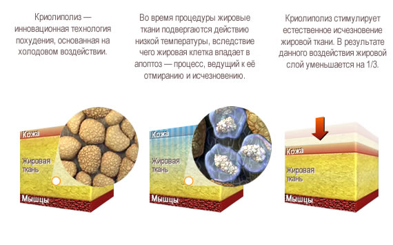 Воздействие криолиполизом