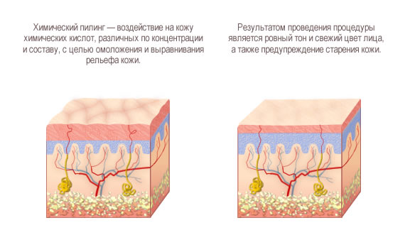 Химический пилинг