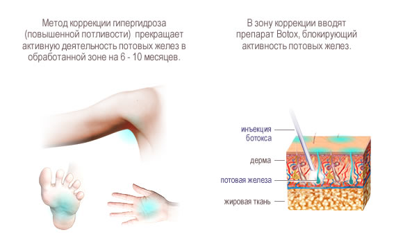 Лечение гипергидроза