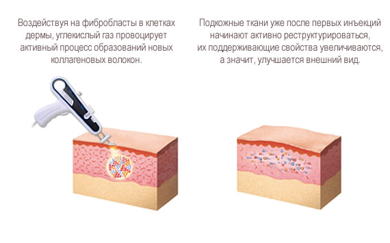 Карбокситерапия