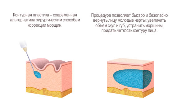 Пластика контура лица