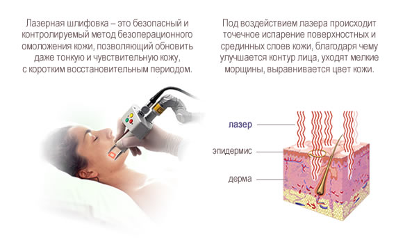 Лазерная дермабразия