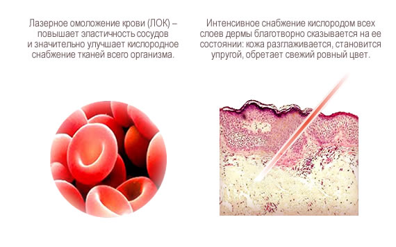 Лазерное омоложение крови