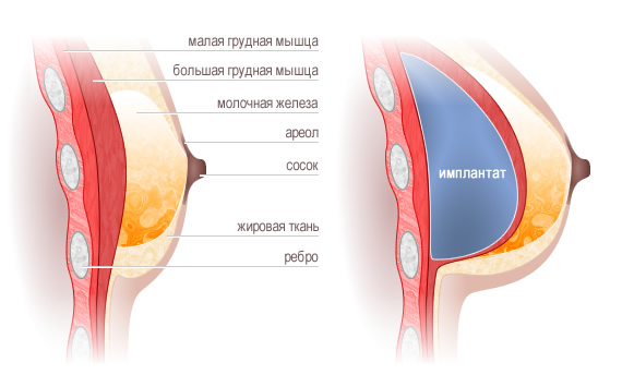 Увеличение молочных желез цена