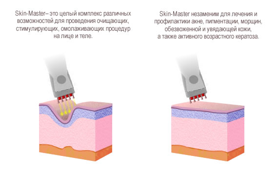 Аппаратная чистка кожи SKIN-Master