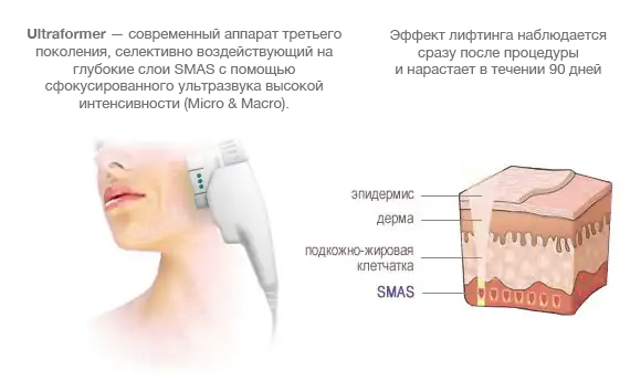 Подтяжка лица на аппарате альтера систем