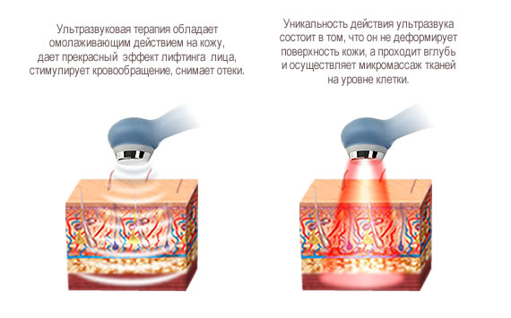 Ультразвуковая терапия