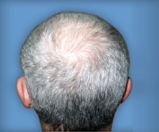 Программа стимуляции роста волос до | пациент 8