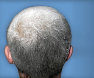 Программа стимуляции роста волос после | пациент 8