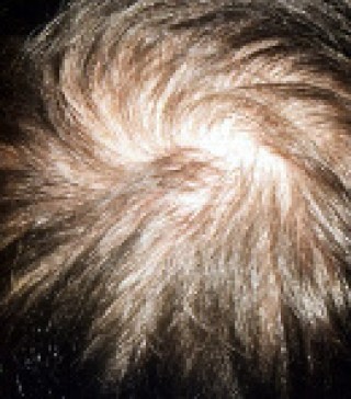 Программа стимуляции роста волос до | пациент 5