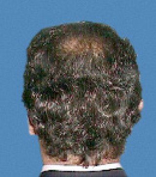 Программа стимуляции роста волос после | пациент 2