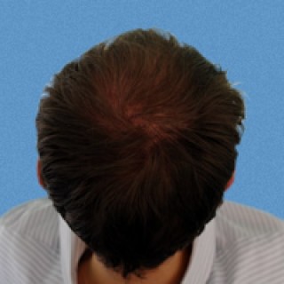 Программа стимуляции роста волос после | пациент 1