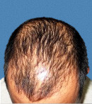 Мезотерапия волос до | пациент 4