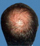 Мезотерапия волос до | пациент 3