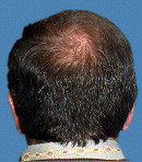 Мезотерапия волос после | пациент 3