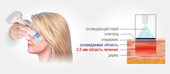 Процедура термолифтинга